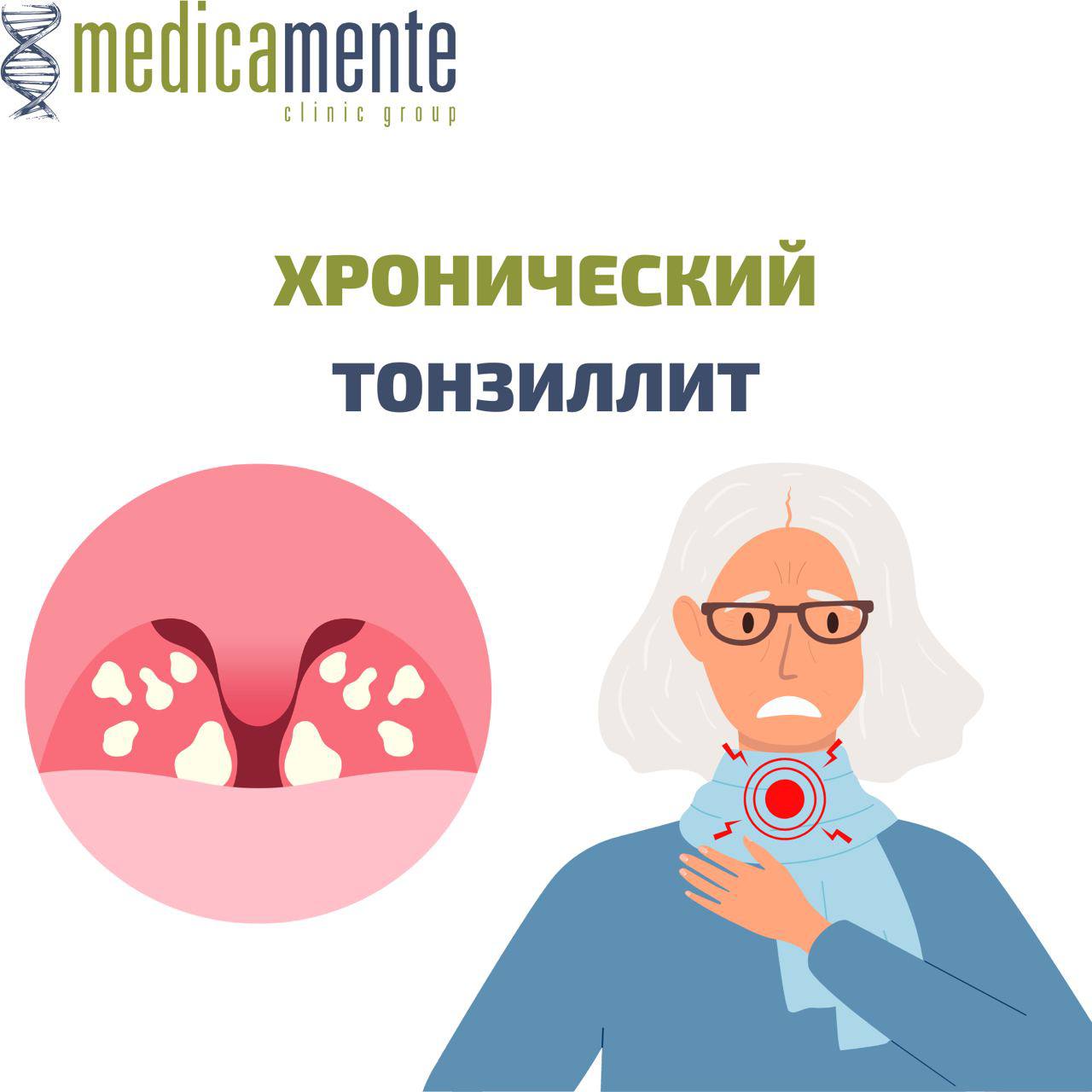 Хронический тонзиллит
